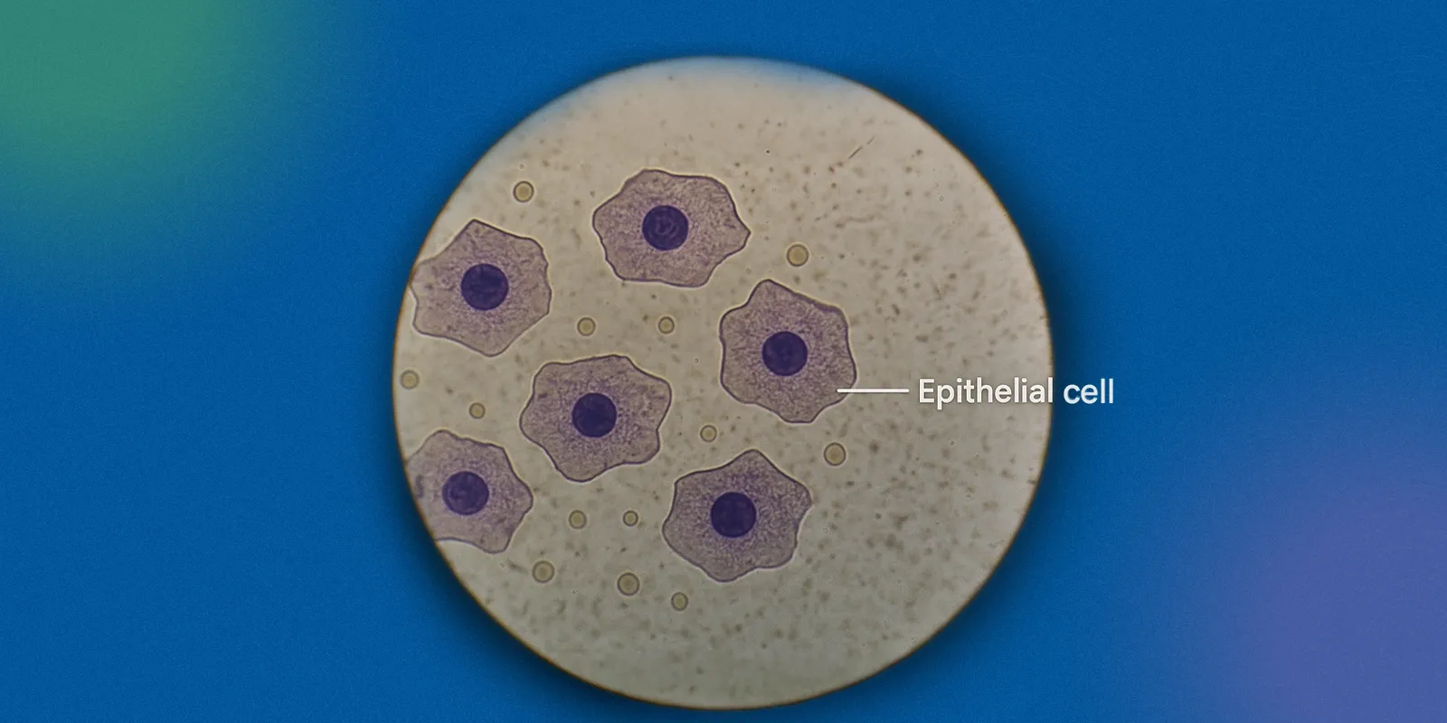Why Are There Epithelial Cells in My Urine