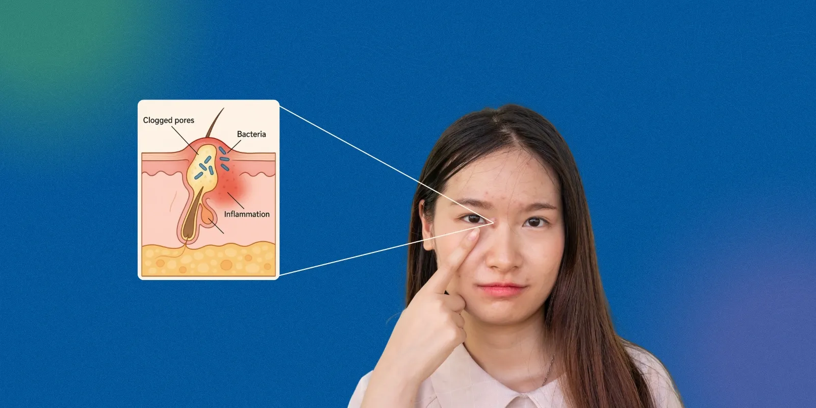 How To Get Rid of Acne
