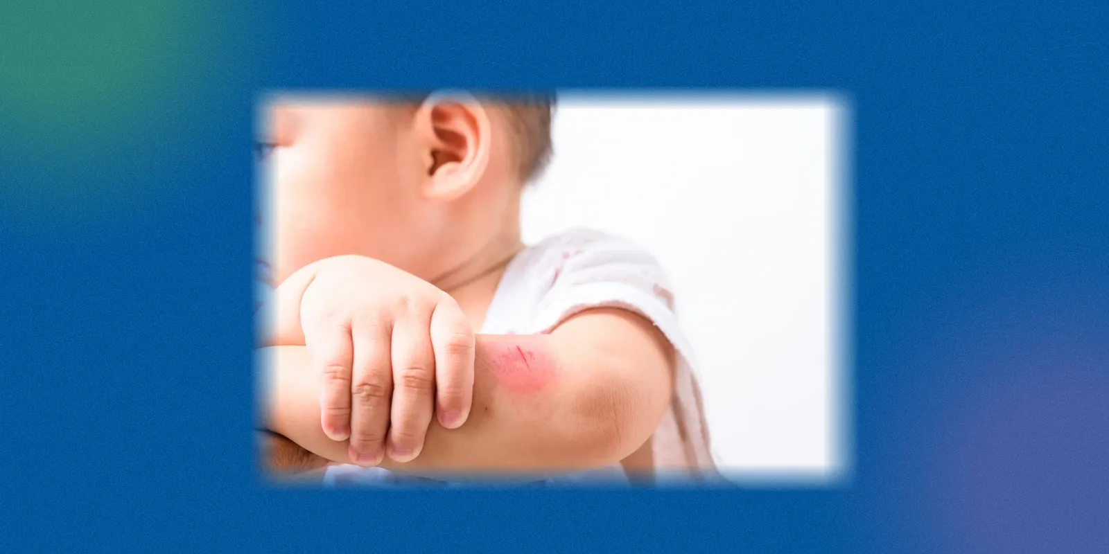 Tetanus Toxoid Vaccine