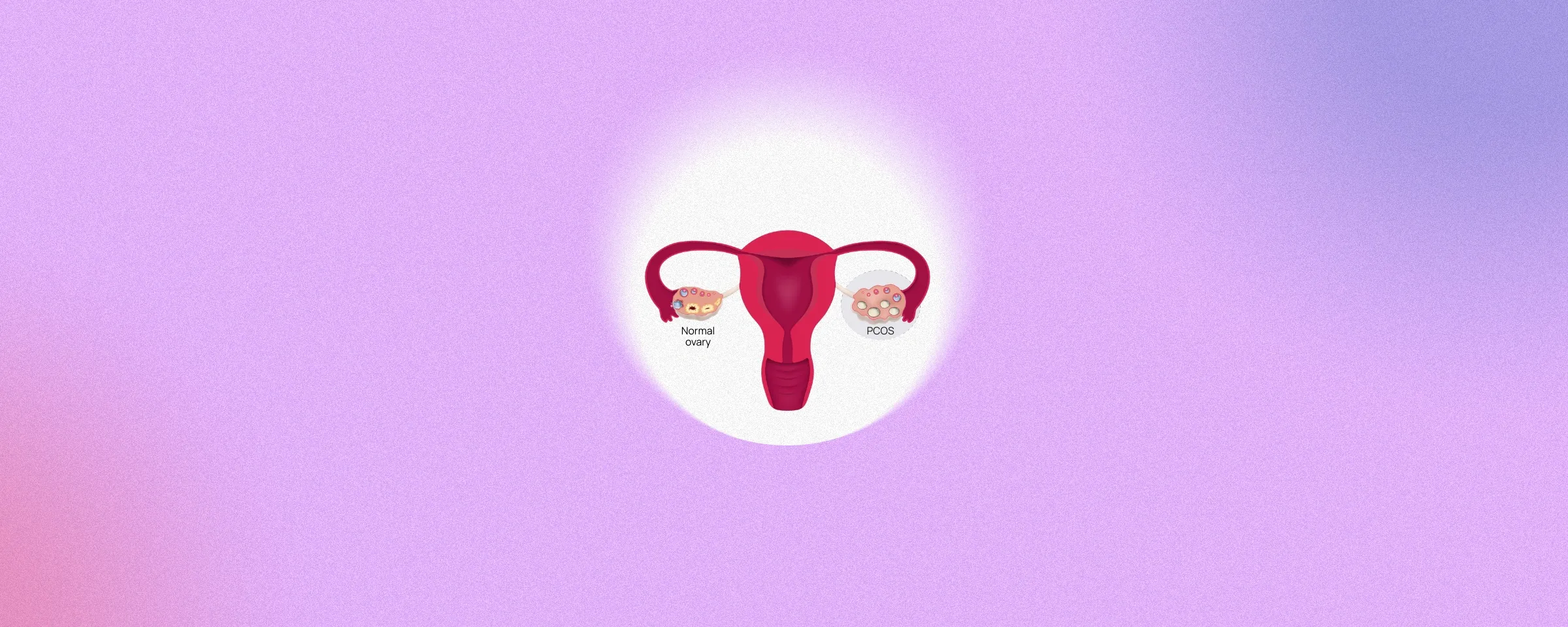 Understanding Polycystic Ovary Syndrome (PCOS): Causes and Overview