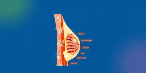 Fibroadenoma Breast Treatment: Why Understanding This Common Lump Matters