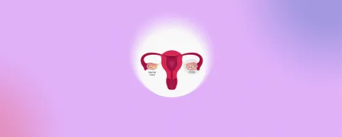 Understanding Polycystic Ovary Syndrome (PCOS): Causes and Overview